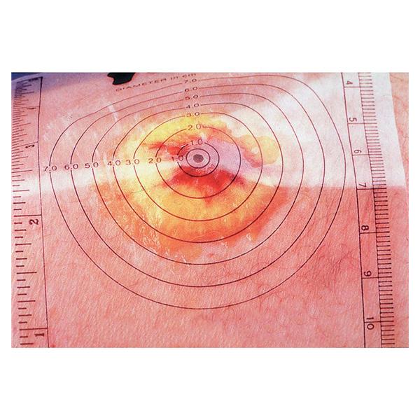 Alimed Sheet Measuring For Wound 250/Bx - 70831