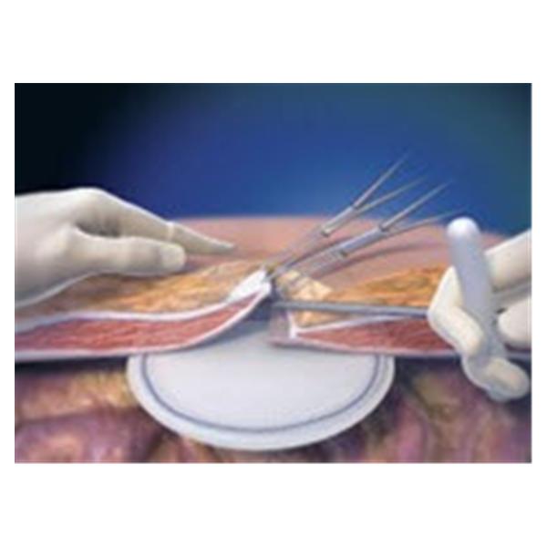 Davol Patch Hernia Ventrio Eptfe 3.1X4.7 1/Ca - 10211