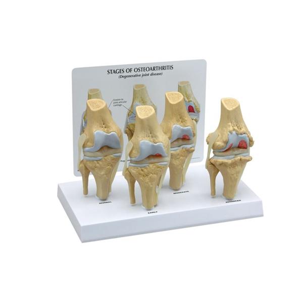 GPI Anatomical Knee Model Anatomical 4-Stage Osteoarthritis 3/4 Scale Ea - 70573